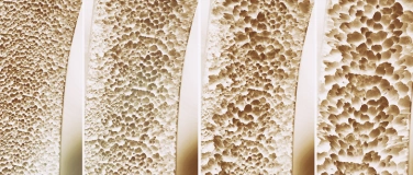 Event-Image for 'Osteoporose – Wie vorbeugen, um Knochenbrüche zu verhindern'